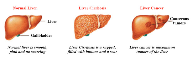 Diagram comparing a healthy liver, fatty liver and cirrhosis